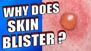 Why Does Skin Blister  How To Treat amp Prevent Skin Blisters Naturally [upl. by Kroy]