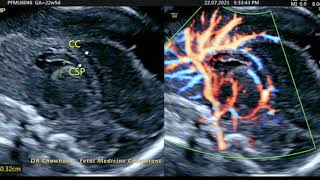 PARTIAL Agenesis of Corpus Callosum [upl. by Arne537]