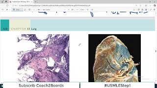 Chp13 Robbins Patho  Lung Pathology  Coal Worker Pneumoconiosis  Restrictive Lung Disorders [upl. by Aihsekel]