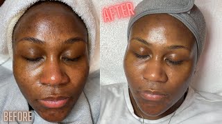 Hyperpigmentation Correction w Microdermabrasion [upl. by Faucher]