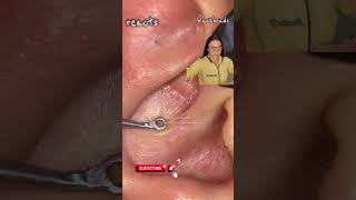 blackhead in ear blackhead in ear removal blackhead in earring hole blackhead in ear extraction [upl. by Anirdna]