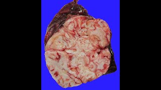 GENERAL PATHOLOGY 50  embryoma hamartoma choristoma DR SAMEH GHAZY [upl. by Aisac982]