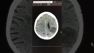 Acute cardioembolic stroke [upl. by Yrellih983]