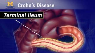 IBD School 102  What is Crohns Disease [upl. by Nahtam]