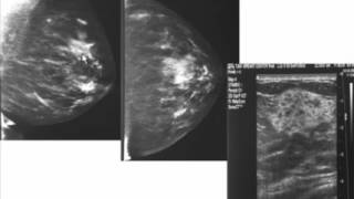 Breast Ultrasound Indications Technique Normal Anatomy [upl. by Reece]