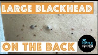 Large Blackheads on the Back [upl. by Ovid]