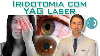 Iridotomia com YAG laser [upl. by Breed683]