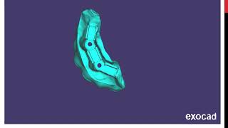 exocadCustomized Subperiosteal Implant for resected maxilla [upl. by Nosemaj]