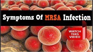 Symptoms Of MRSA Infection The Symptoms Will Help Indicate How Much MRSA Has Spread And Affected [upl. by Nahum]