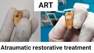 Atraumatic restorative treatment session community dentistry [upl. by Viquelia154]