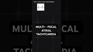 multifocal atrial tachycardia  ECG basics [upl. by Bergess]