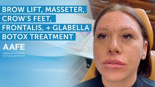 Brow Lift Masseter Frontalis and Glabella Botox Treatment  AAFE [upl. by Adekan780]