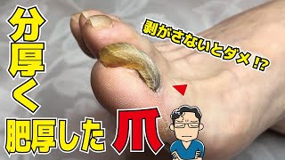 肥厚爪（爪甲鉤彎症）のケア【分厚くて切れない爪】 [upl. by Gnihc]