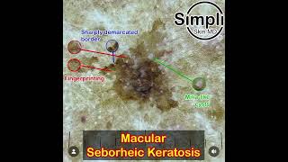 Macular Seborrheic Keratosis Dermoscopy [upl. by Elvin]