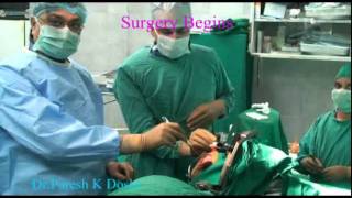 DBS Surgery for Parkinsons disease  DrParesh K Doshi [upl. by Yrruc789]