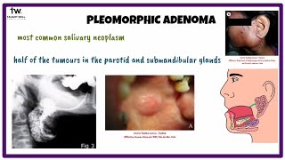 Pleomorphic Adenoma  Oral Medicine [upl. by Rawde]