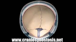 Metopic Synostosis Helmet Therapy Growth Superior  Craniosynostosis Surgery [upl. by Jerol663]