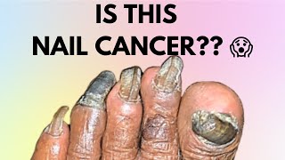 IS THIS NAIL CANCER symptoms  HOW TO IDENTIFY NAIL CANCER  SUBUNGUAL MELANOMA  MELANOMA [upl. by Fisoi]