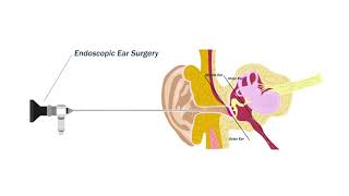 Ear Drum Ear Perforation Repair [upl. by Cranford]