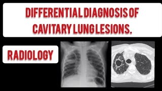 Pulmonary cavities  RADIOLOGY  Differential Diagnosis of Cavitary Lung Lesions [upl. by Rednirah31]