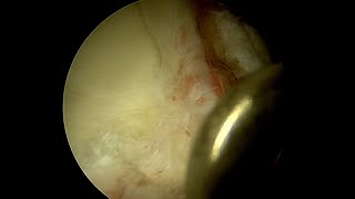 Previously Repaired Labrum with Multiplanar Grade 3 Complexity [upl. by Eyde]