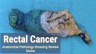 Rectal Cancer  Lymph Node Hunt  Anatomical Pathology Grossing Review Series [upl. by Ziana618]