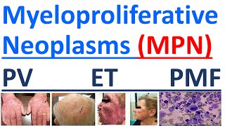 Myeloproliferative Neoplasms explained [upl. by Elynad]