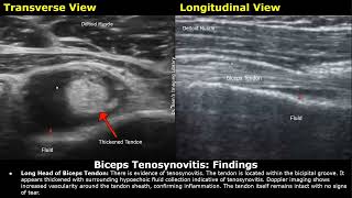 Shoulder Ultrasound Reporting  Supraspinatus Tendinosis Tears Biceps Tendon Joint Effusions USG [upl. by Analrahc]