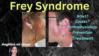 226 Freys Syndrome Information Prevention Treatment Explained dentallectures [upl. by Korman]