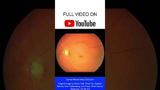 Central Retinal Artery Occlusion Fundoscopy shorts [upl. by Mas844]