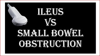 Ultrasound of ileus VS small bowel obstruction [upl. by Adnar]