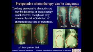 Strategy of treatment of osteosarcoma [upl. by Atires]