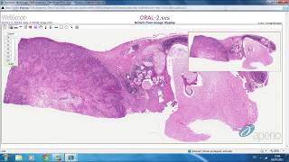 Mucoepidermoid Carcinoma Salivary gland tumor 🔬salivarygland cancer tumors [upl. by Ruff]