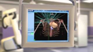 CyberKnife® Radiation Therapy What It Is amp How It Works [upl. by Galliett529]