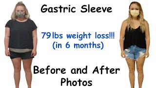 Gastric Sleeve Before and After Pictures and Results part 3  Bariatric Weight Loss Journey [upl. by Merth]