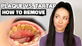 Plaque vs Tartar  How To Remove Plaque From Teeth [upl. by Berlauda]