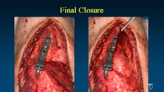 Fixation Options and Techniques for Distal Humerus Fractures VuMedi [upl. by Barnebas]