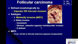 Thyroid Carcinoma Gross and Micro [upl. by Arlan]