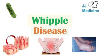 Whipple Disease  Causes Risk Factors Pathophysiology Symptoms Diagnosis Treatment [upl. by Aremus]