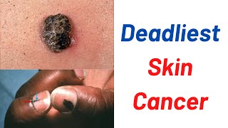 The deadliest skin cancer [upl. by Fritz]