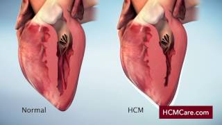 Hypertrophic Cardiomyopathy HCM Mechanism of Disease Video [upl. by Llenna]