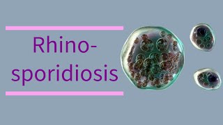 Rhinosporidiosis  clinical features  diagnosis  histopathology [upl. by Adrea]