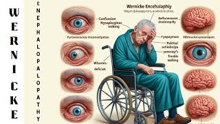 Understanding Wernicke Encephalopathy Symptoms Diagnosis Treatment [upl. by Esorylime738]