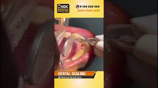 Dental Scaling  Step by Step  Painless Dental Treatment  NDC [upl. by Anoynek]