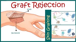 Graft rejection  Immunological basis of graft rejection [upl. by Eiloj457]