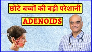 Adenoids kya hota hai । Enlarged adenoids । बच्चों में खराटे । Hindi [upl. by Jacobs]