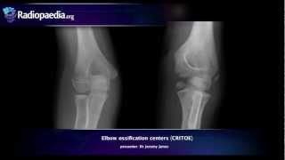 Elbow ossification centers CRITOE  radiology video tutorial [upl. by Oniger277]