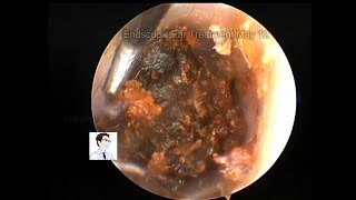 Review of hard cerumen embolism May 13 2022 [upl. by Kayley]