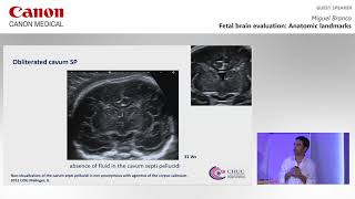 ISUOG 2019  Miguel Branco on utilizing ultrasound imaging techniques during fetal brain evaluation [upl. by Akiram]