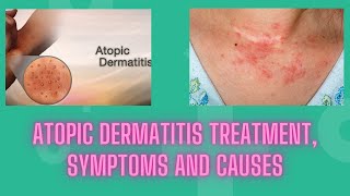 Atopic dermatitis treatment symptoms and causes  Nuse Healthy [upl. by Yetak]